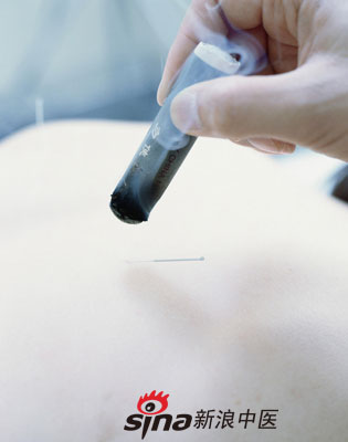 點(diǎn)擊將在新窗口查看全圖 反復(fù)咳嗽 試試中醫(yī)特色療法